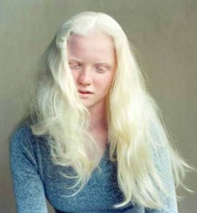 albinism-002